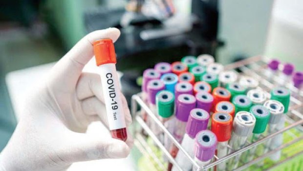 COVİD-19-un bu günə olan statistikası - 1410 yeni yoluxma