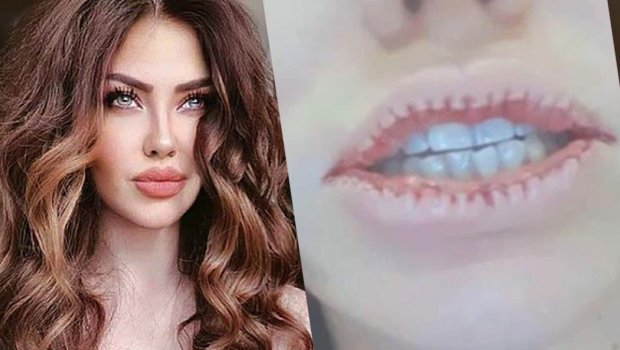 Türkiyəli müğənni estetik əməliyyatdan sonra dodaqlarını tərpədə bilmir - ŞOK VİDEO 