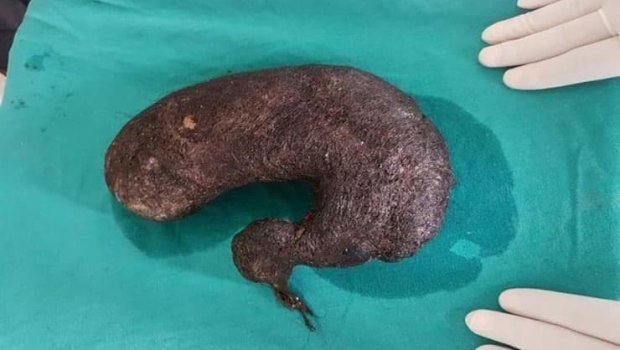 Mədəsindən 2 kiloya yaxın saç tükü çıxdı - FOTO