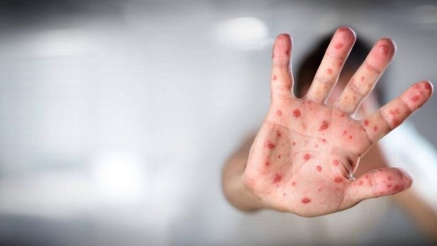Azərbaycanda meymunçiçəyinə yoluxan var? - Nazirlik AÇIQLADI 