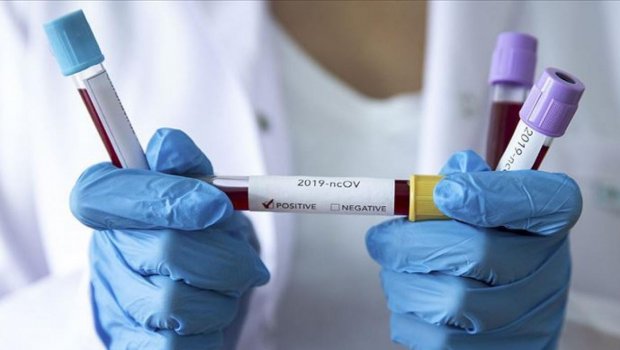 Azərbaycanda son sutkada 161 nəfər COVID-19-a yoluxdu
