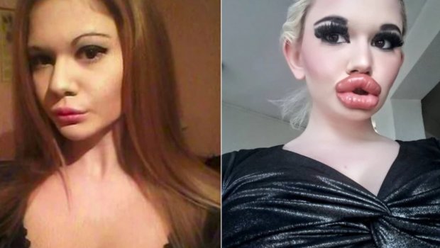 Dodağını 32 dəfə böyüdən model görünüşü ilə MƏƏTTƏL QOYDU - FOTO 