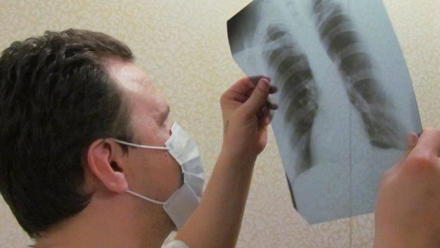 Azərbaycanda vərəmə yoluxmanın STATİSTİKASI 