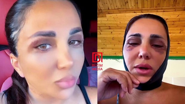 Zenfira gözəlləşmək üçün bıçaq altına uzandı - VİDEO