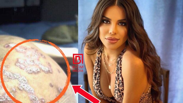 Azərbaycanlı modelin plastik əməliyyatlardan bədəni bu hala düşdü - DƏHŞƏT - FOTO