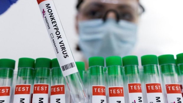 Vyetnamda insanlar arasında ilk meymunçiçəyinə yoluxma halı qeydə alınıb