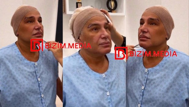 Samir Bağırov plastik əməliyyat keçirdi - ÖZƏL/VİDEO 