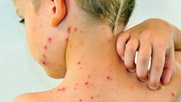 Azərbaycanda uşaqlar arasında qızılcaya yoluxma ARTIB – TƏBİB  