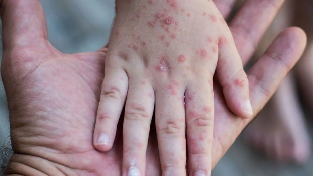 Əvvəlki illərdə qızılcadan ÖLÜM sayı nə qədər olub? – NAMƏLUM STATİSTİKA