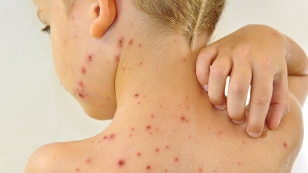 Qızılcadan ölüm halları niyə ARTIR? – Xəstəliyin yeni forması ilə bağlı XƏBƏRDARLIQ  