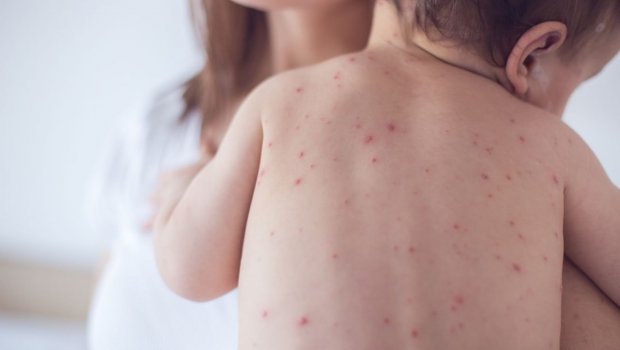1 yaşına qədər olan körpələrin qızılcaya yoluxması və ölüm təhlükəsi nə QƏDƏRDİR? - Pediatrdan AÇIQLAMA