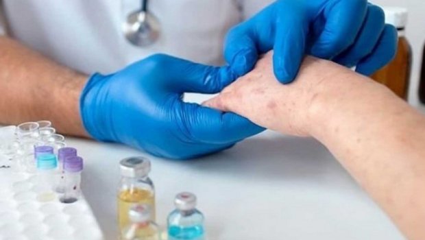ÜST-ə görə qızılcaya ən yüksək yoluxma Azərbaycandadır – Bəs rəsmi statistika NƏ DEYİR? 