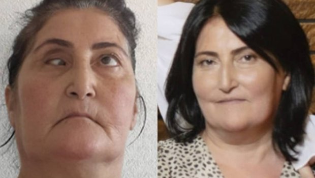 Burun əməliyyatına girən qadının gözündə çəplik yarandı - FOTO/VİDEO