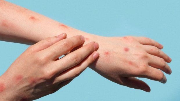 Meymunçiçəyinin qarşısı bu halda alına bilər &ndash; ÜST rəhbəri