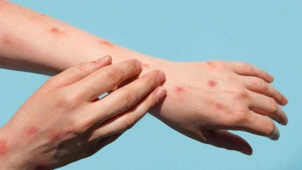 Azərbaycanda meymunçiçəyinə yoluxma aşkarlanıb? &ndash; RƏSMİ AÇIQLAMA 