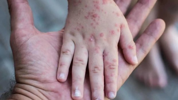 Qızılcaya yoluxma TƏHLÜKƏSİ yenidən artır &ndash; Ölkədə epidemioloji durum NECƏDİR?