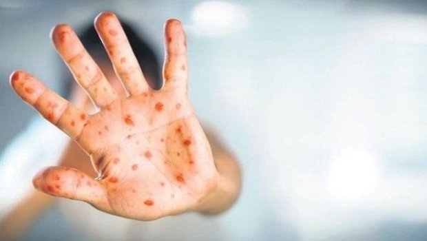 Azərbaycanda meymunçiçəyi virusuna yoluxma faktı aşkarlanıb - RƏSMİ