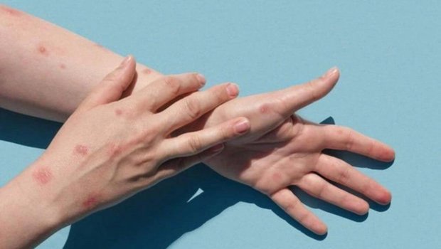 Meymunçiçəyi ilə bağlı XƏBƏRDARLIQ &ndash; Ölkəmizdə kütləvi vaksinasiya BAŞLAYIR?