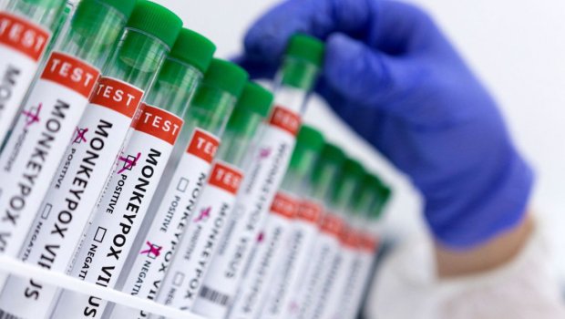 Meymunçiçəyinə yoluxanlar üçün antibiotik istifadəsi zərərlidir &ndash; RƏSMİ