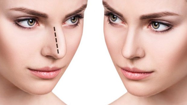 Kimlərə rinoplastika əməliyyatı olmaz?