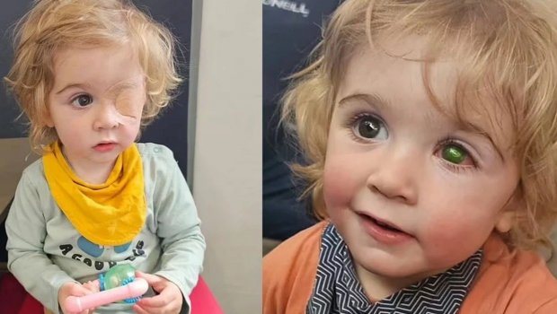 İki yaşlı uşaq bir öpüşə görə gözünü itirdi – FOTO