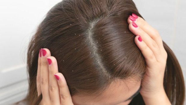 Kəpəyə qarşı effektiv şampunu necə SEÇMƏK OLAR?