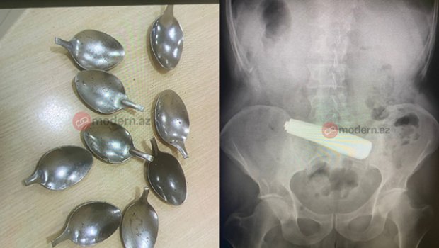 Bakı sakini 9 ədəd qaşıq uddu &ndash; FOTO