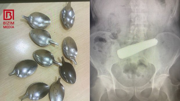 Bakıda 9 ədəd qaşıq udan şəxsin 55 yaşı var &ndash; TƏFƏRRÜAT