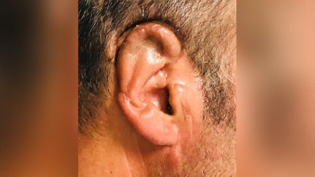 Qopan qulağı 34 saat sonra yerinə tikildi - FOTO