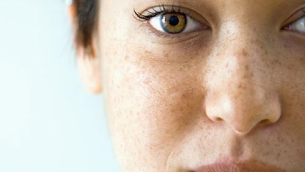 Günəş ləkələrindən qorunmanın QAYDALARI