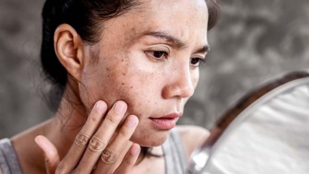 Dermatoloqdan xəbərdarlıq: Günəş yanığına qarşı bu addımları atın
