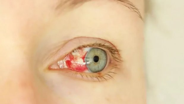 Göz qanaması ilə başlayan gizli virus yayılır