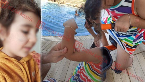 Lənkəranda qandonduran HADİSƏ – Ana isti qaşıqla 3 yaşlı qızının qolunu DAĞLADI – FOTO/VİDEO
