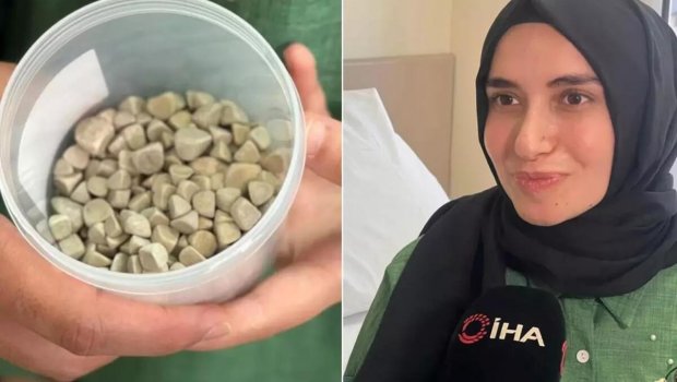 21 yaşlı Fatmanın bədənindən 287 daş çıxarıldı – FOTO