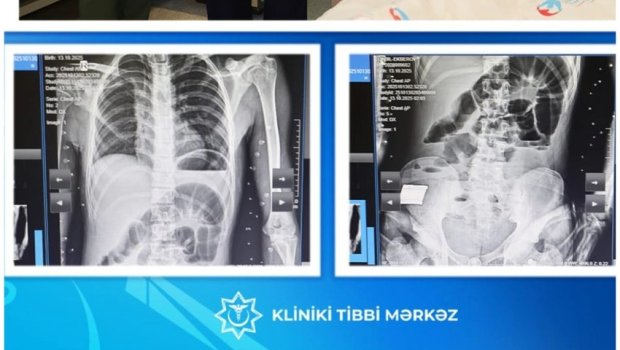 Bakıda 17 yaşlı yeniyetmə taxta UDDU – FOTO