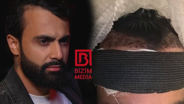 Hüseyn Həsənov saç əkdirdi - FOTO