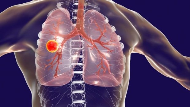 Azərbaycanda vərəmə yoluxanların sayı AZALIB – RƏSMİ