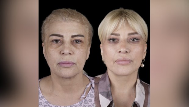 Mətanət İsgəndərli əməliyyatla belə dəyişdi – FOTO