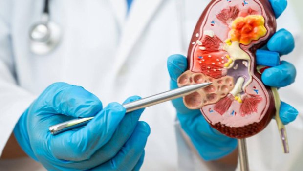 Böyrək daşlarının yaranmasına səbəb olan qidalar açıqlandı