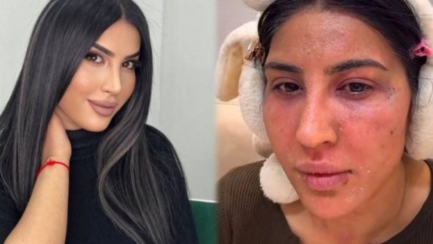 Reklam etdiyi pilinq Ləmanın üzünü yandırdı