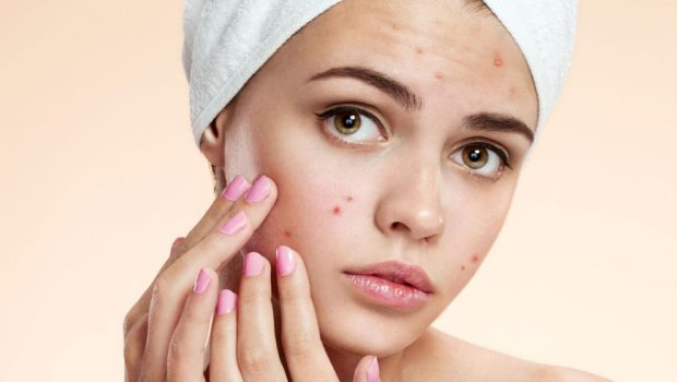 Sızanaqlardan təbii yollarla qurtulmağın effektiv üsulları