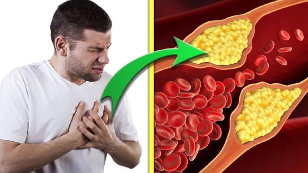 Xolesterolu dərmanlardan daha yaxşı aşağı salan unudulmuş MƏHSUL