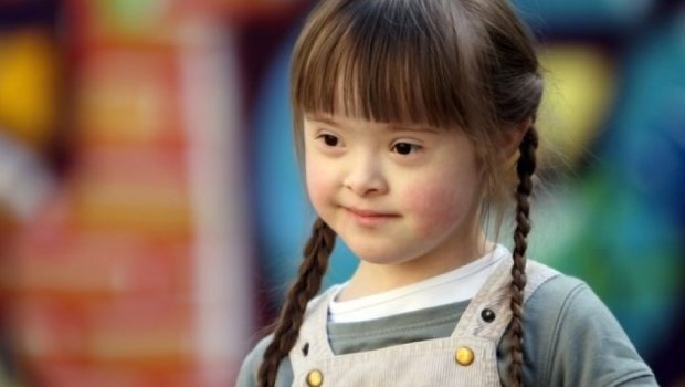 Naxçıvanda daun sindromlu uşaqların sayı açıqlanıb