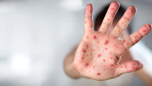 Rusiyada meymunçiçəyinə yeni yoluxma qeydə alınıb