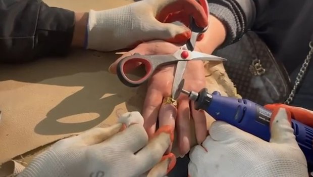 Barmağında sıxışan üzüyü belə çıxardılar &ndash; VİDEO