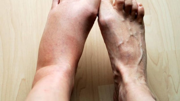 Ödemin gözlənilməz səbəbi AŞKARLANDI: Hansı qidalar şişkinliyi artırır?