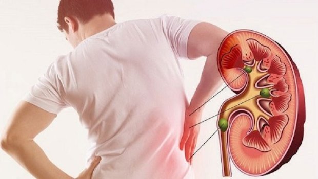 Böyrəkdə daşların yaranma səbəbləri açıqlandı