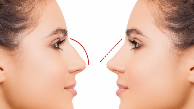 Azərbaycanda bu şəxslərə burun əməliyyatı pulsuz oldu