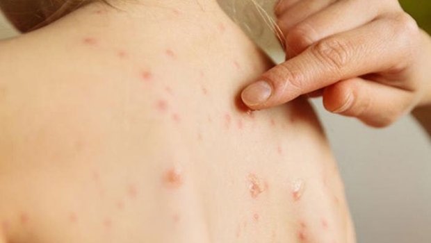 Uşaqlar arasında suçiçəyi yayılıb? &ndash; RƏSMİ AÇIQLAMA