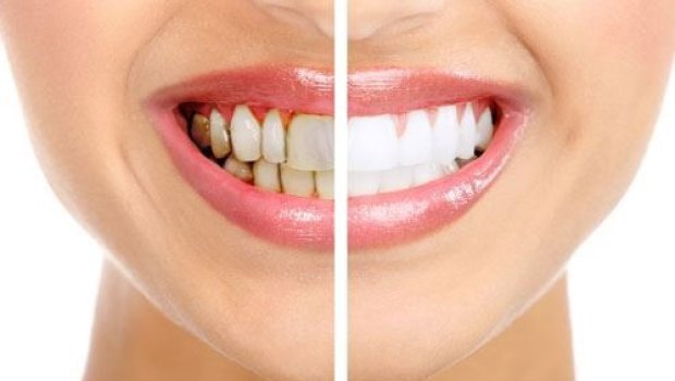 Həkim dişləri çürüdən qidaları AÇIQLADI